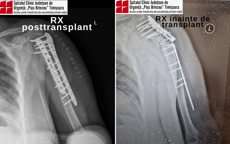 fractura-humerus - Sursa de Vest