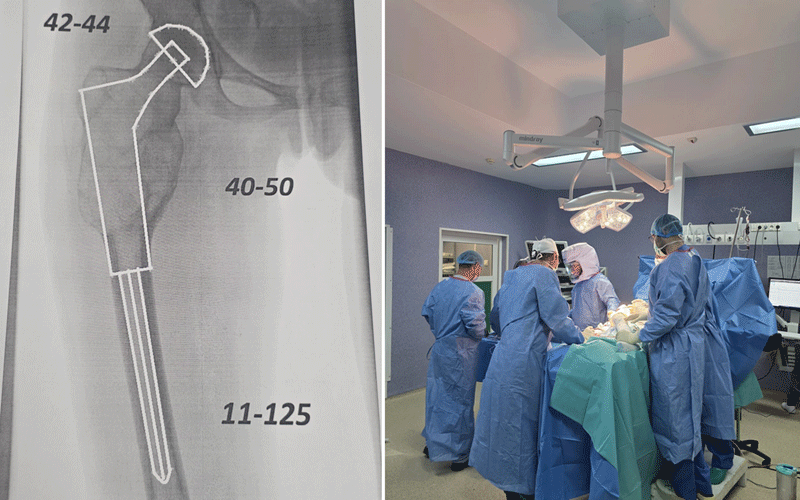 judetean-operatie2 - Sursa de Vest Composite image showing an X-ray of a hip prosthesis on the left and a surgical team performing hip surgery in an operating room on the right.
