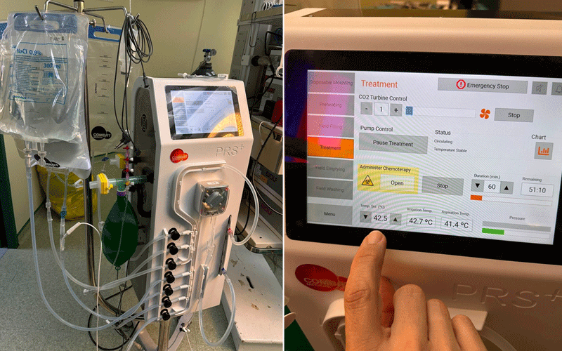 operatie-judetean - Sursa de Vest ICU dialysis/CRRT machine with IV bags and tubing connected to the device; right panel shows the touchscreen control with treatment settings.