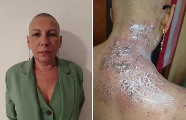Side-by-side: a woman wearing a green blazer on the left and a close-up of severely itchy, peeling skin on the neck and shoulder on the right.